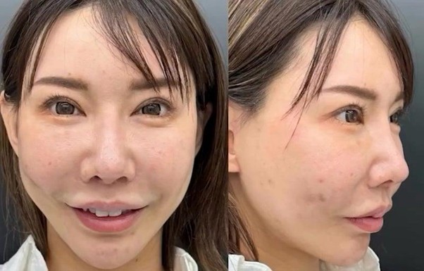 頬のヒアルロン酸オーバー注入