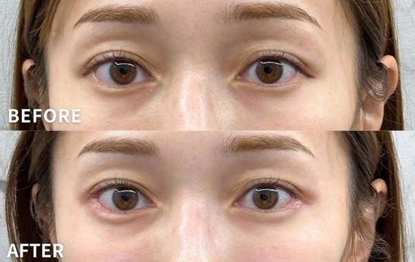 涙袋•目周りヒアルロン酸直後