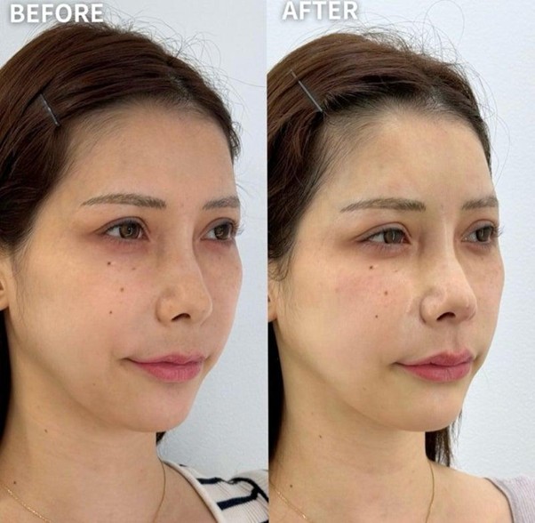 唇ヒアルロン酸 1DAY