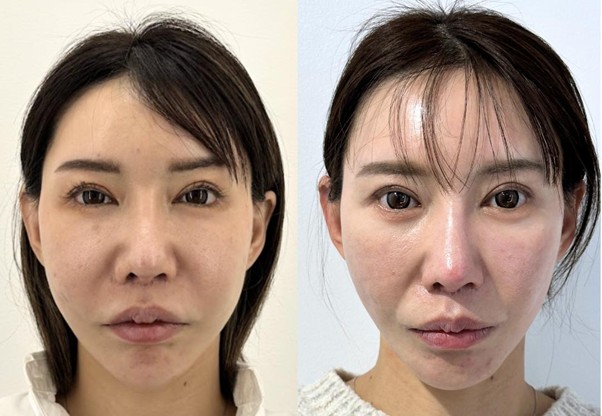 他院修正 頬ヒアルロン酸溶解注射