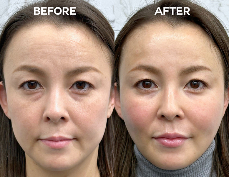 バッカルファット減量術