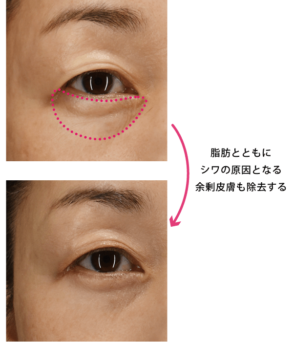 目の下の脱脂 + 余剰皮膚切除