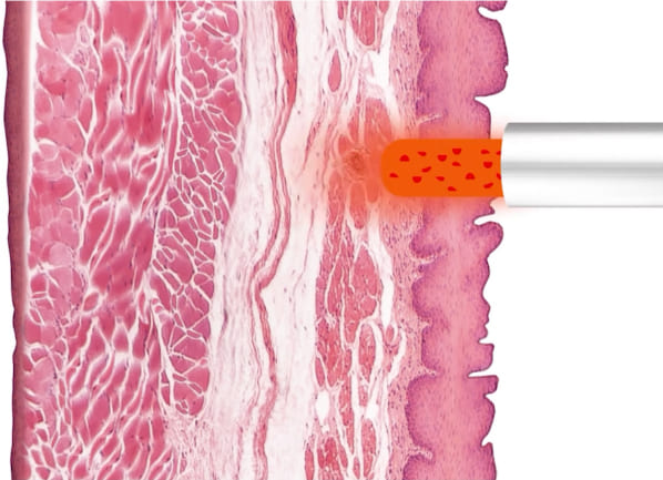 2D フラック3リジュビネーションの照射イメージ