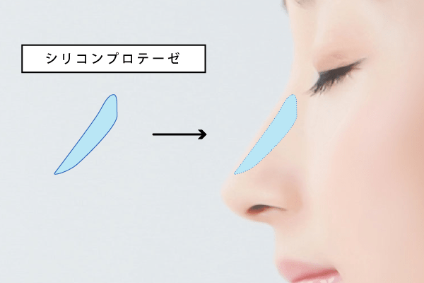 医療用プロテーゼ(人工物)