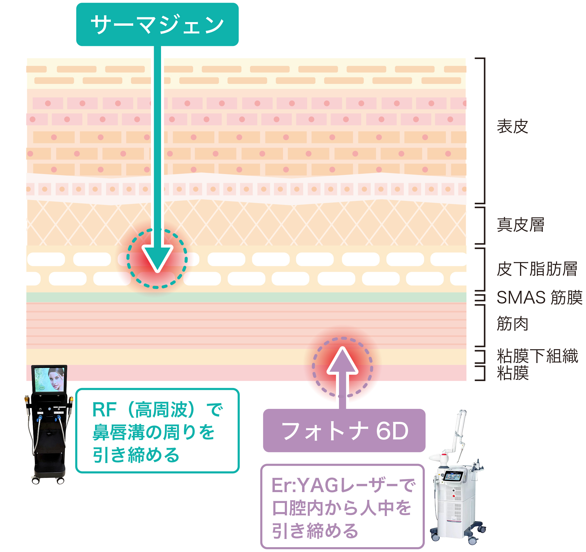 サーマジェンとFotona6Dの違い