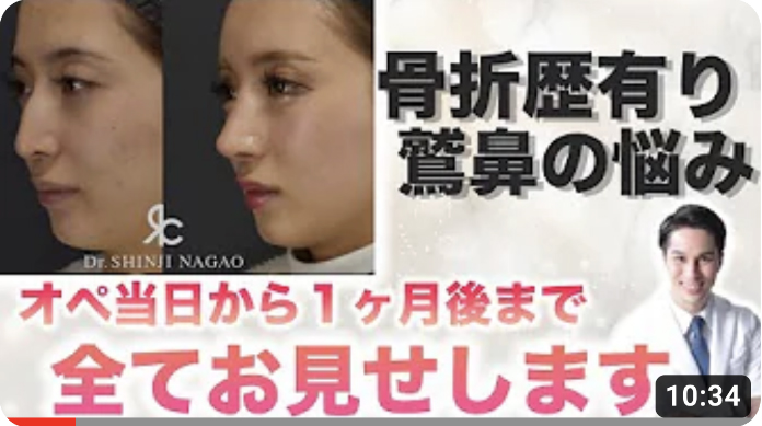 骨折歴有り鷲鼻の悩み。オペ当日から1ヶ月後まで全てお見せします。