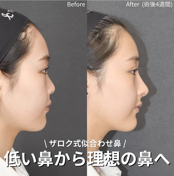 ザロク式に合わせ鼻 低い鼻から理想の鼻へ