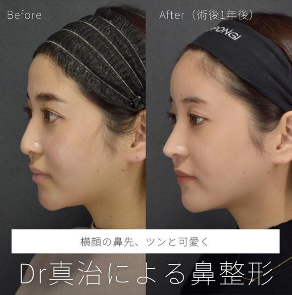 横顔の鼻先、ツンと可愛く Dr真治による鼻整形