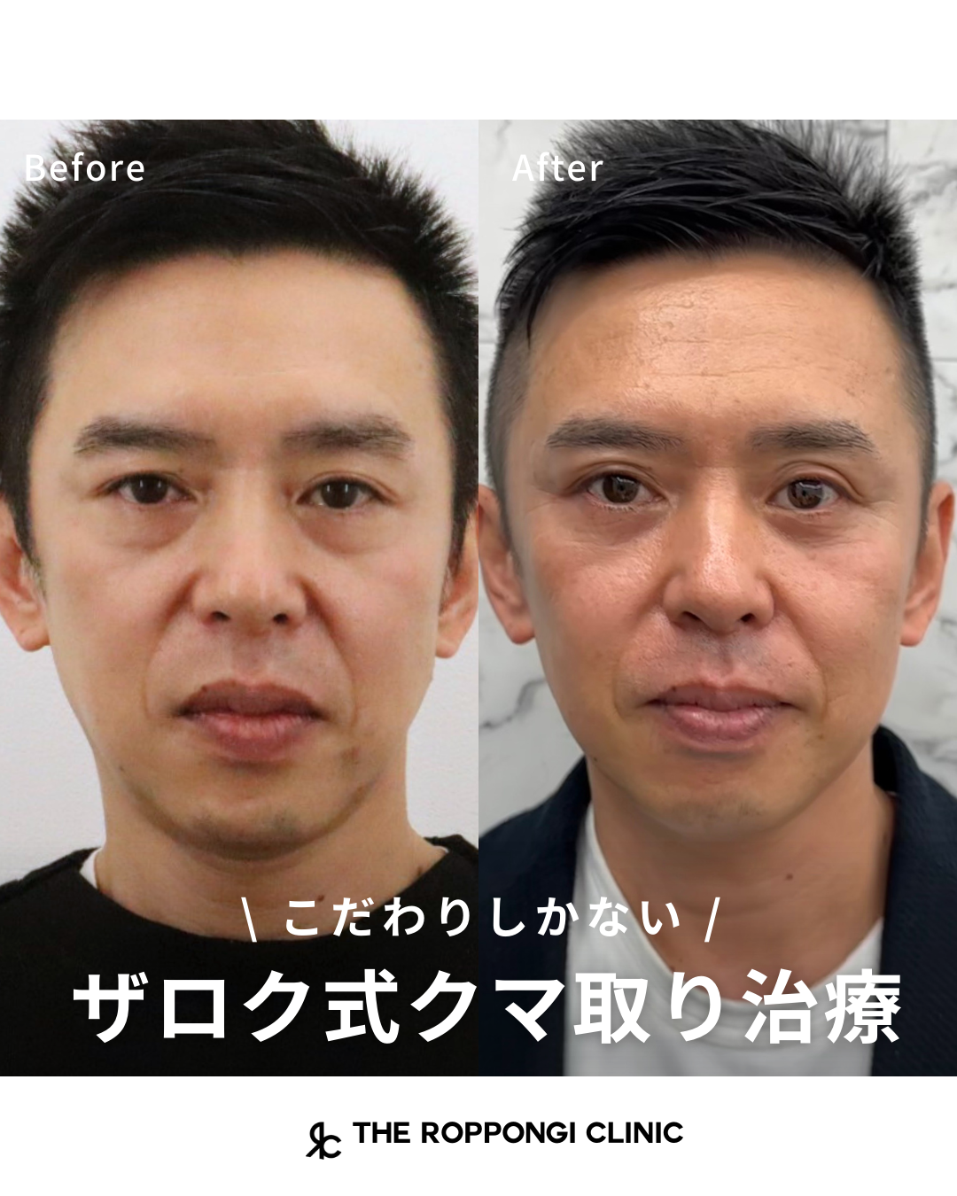 ザロク式目の下のクマ取り