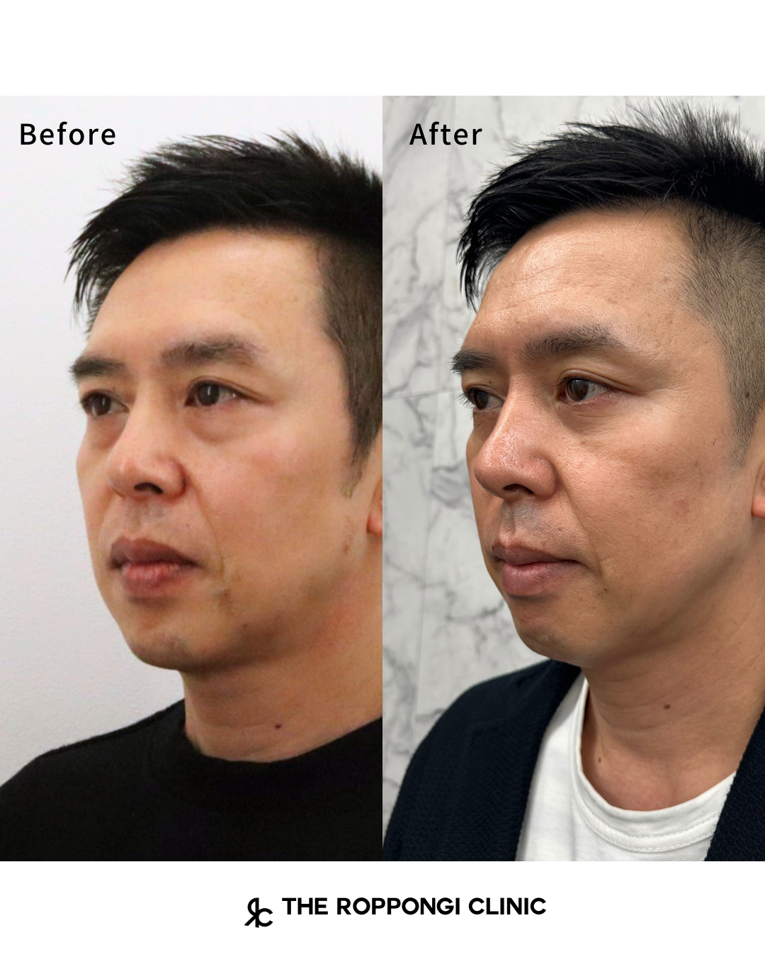 目の下のクマ取り、脱脂