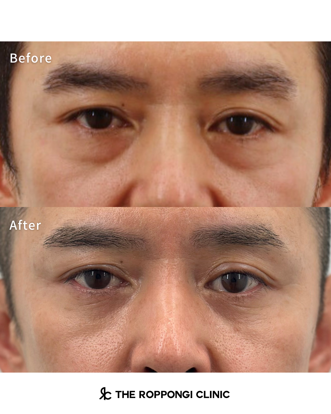 目の下のクマ取り、脱脂