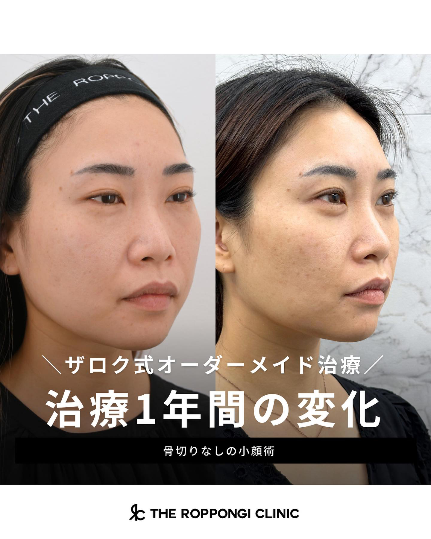 脂肪の足し算引き算で小顔に?脂肪で作る曲線美