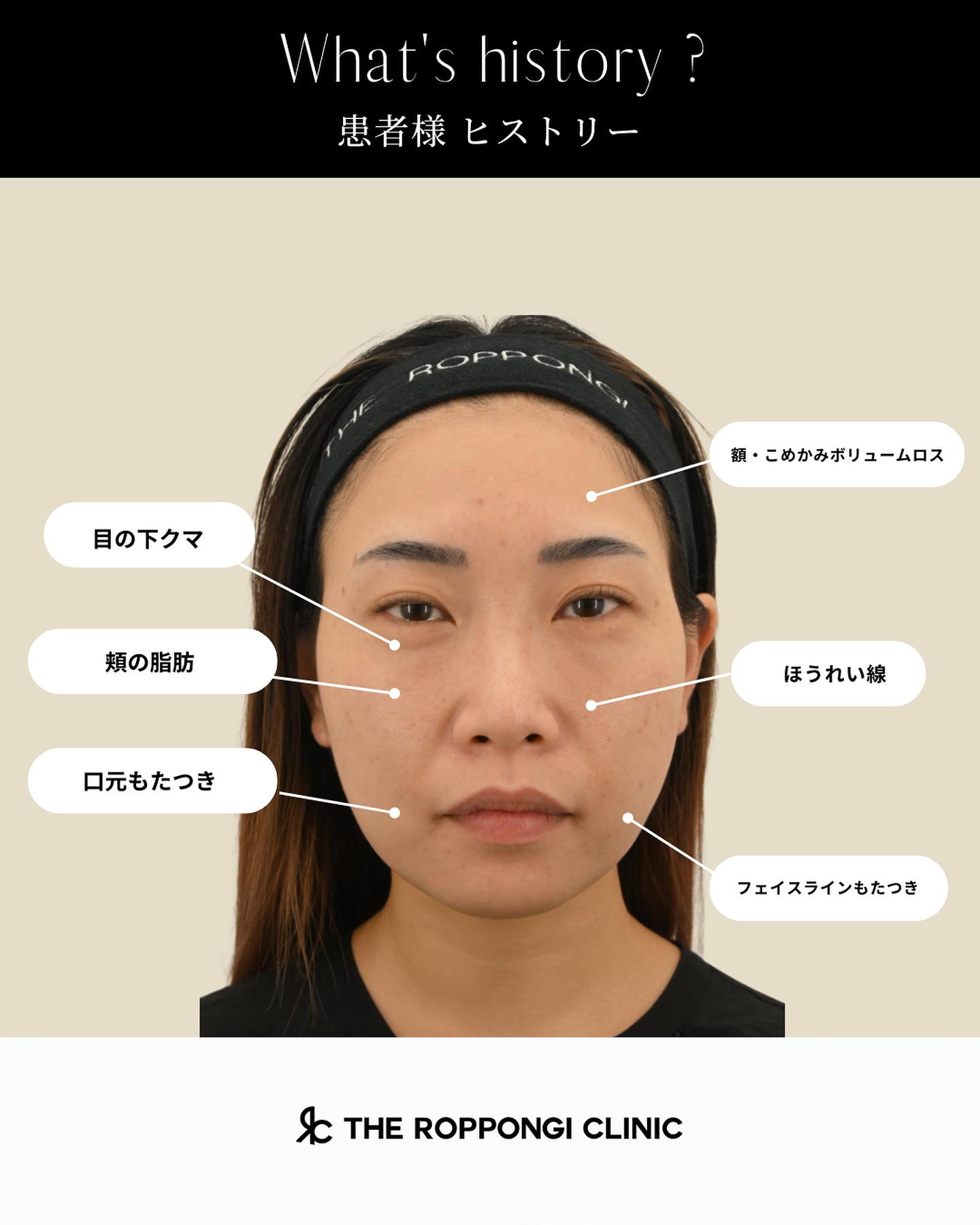 ヒアルロン酸注射、ボトックス注射、バッカルファット、顔の脂肪吸引