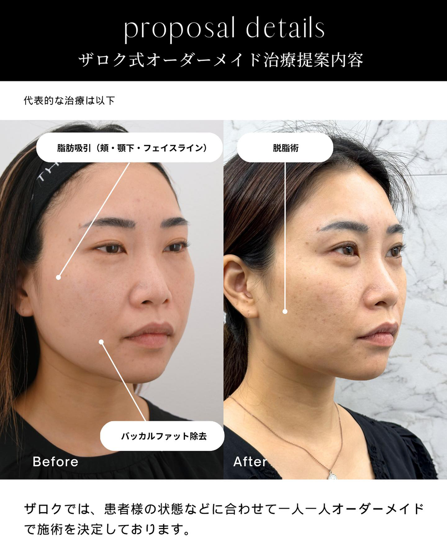 ヒアルロン酸注射、ボトックス注射、バッカルファット、顔の脂肪吸引