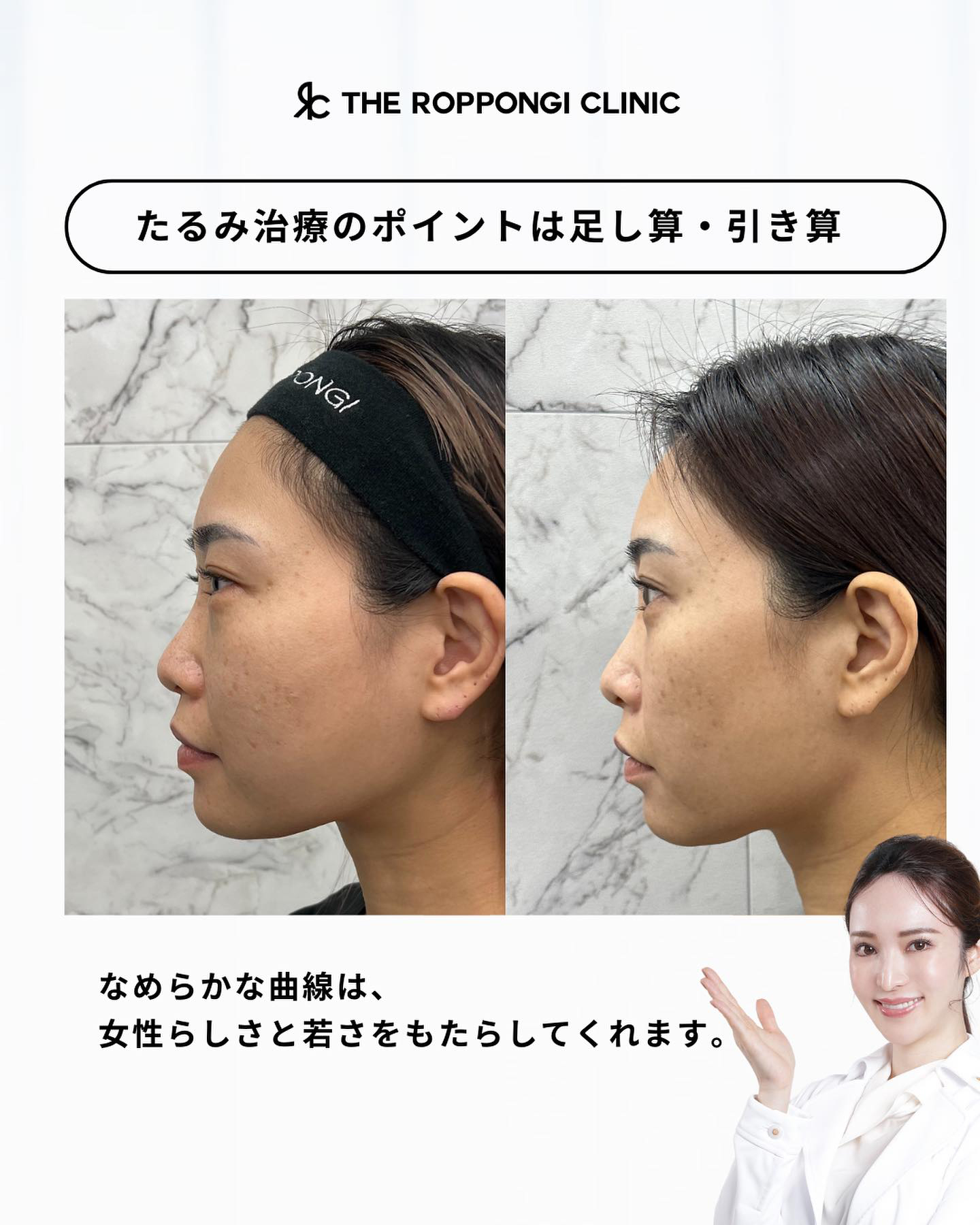 ヒアルロン酸注射、ボトックス注射、バッカルファット、顔の脂肪吸引