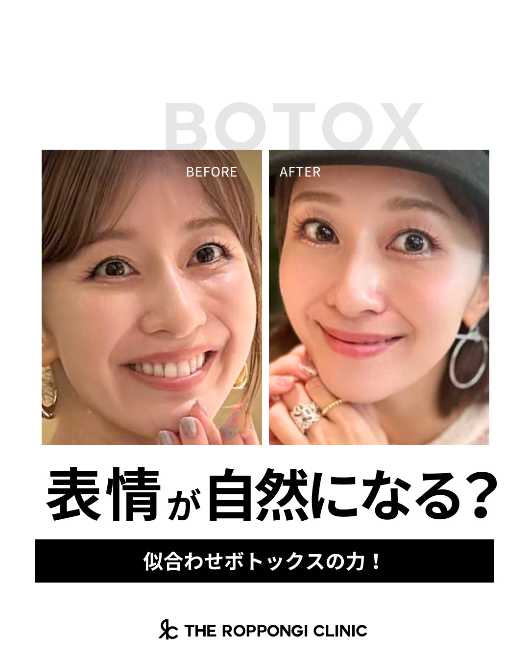 表情が自然になる?!似合わせボトックスの力!