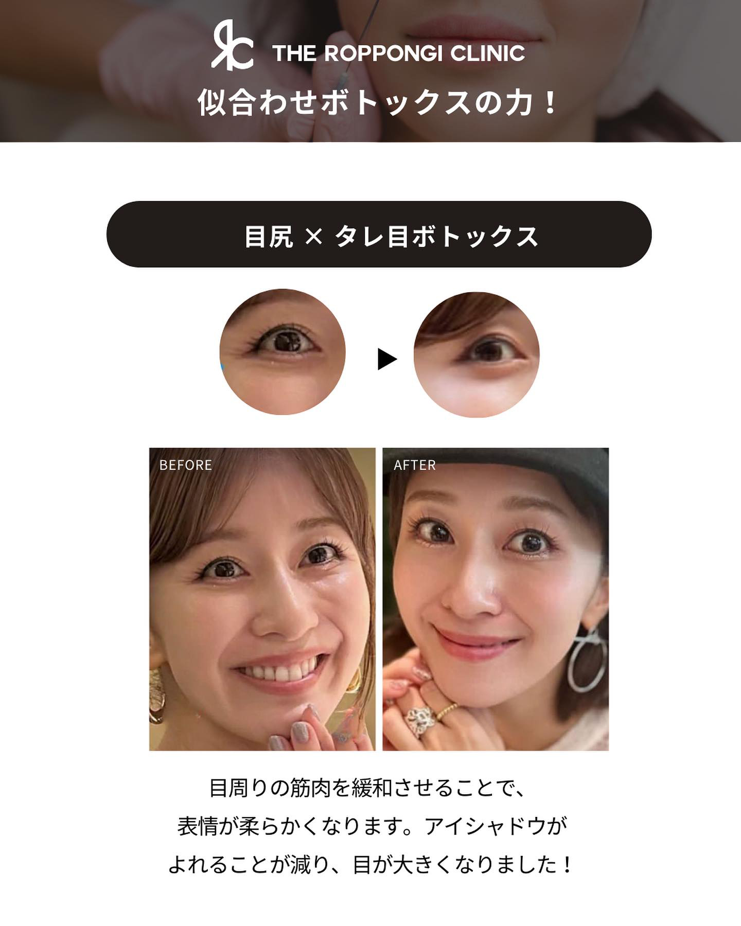 ボトックス注射、ピコトーニング、フォトフェイシャル