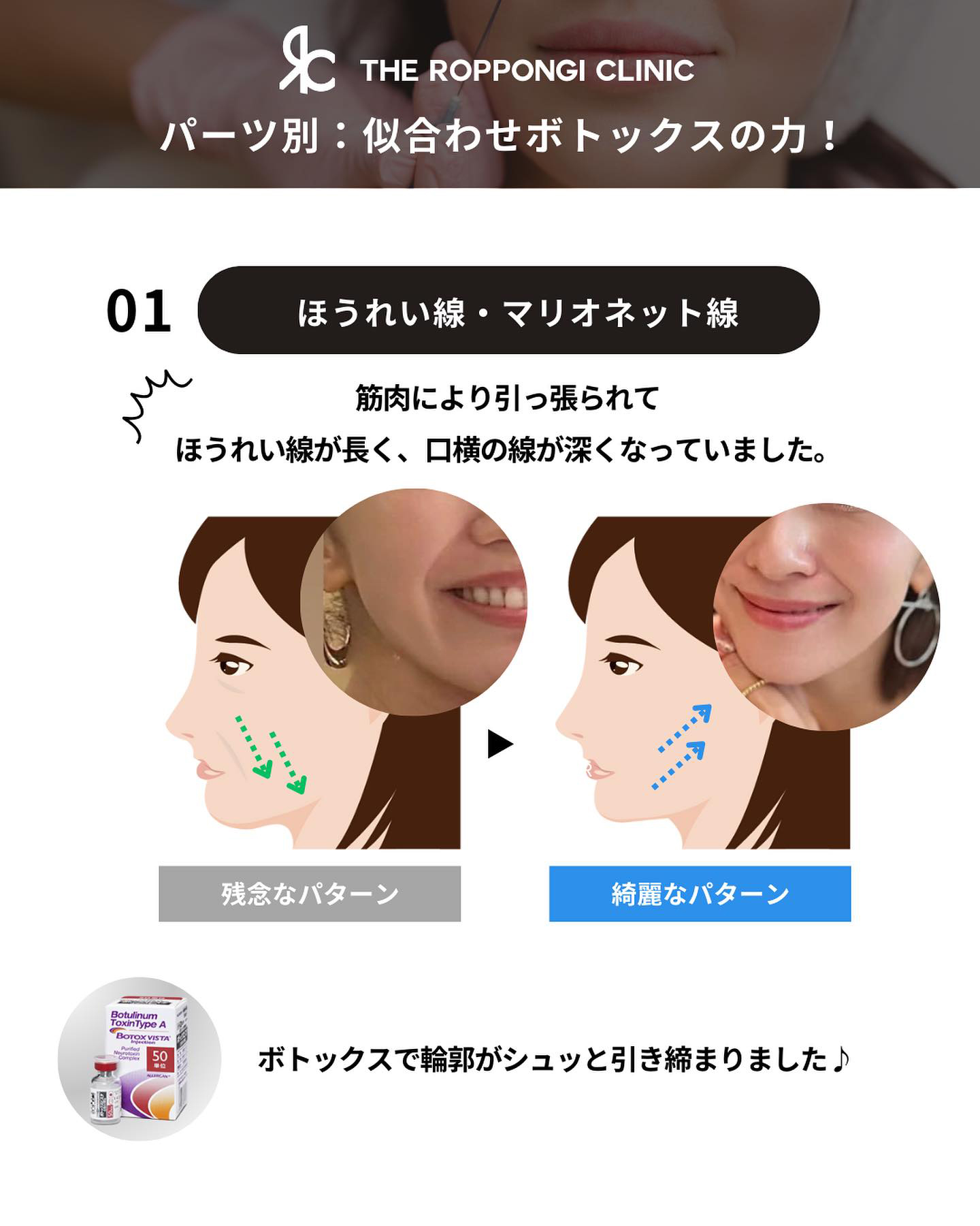 ボトックス注射、ピコトーニング、フォトフェイシャル