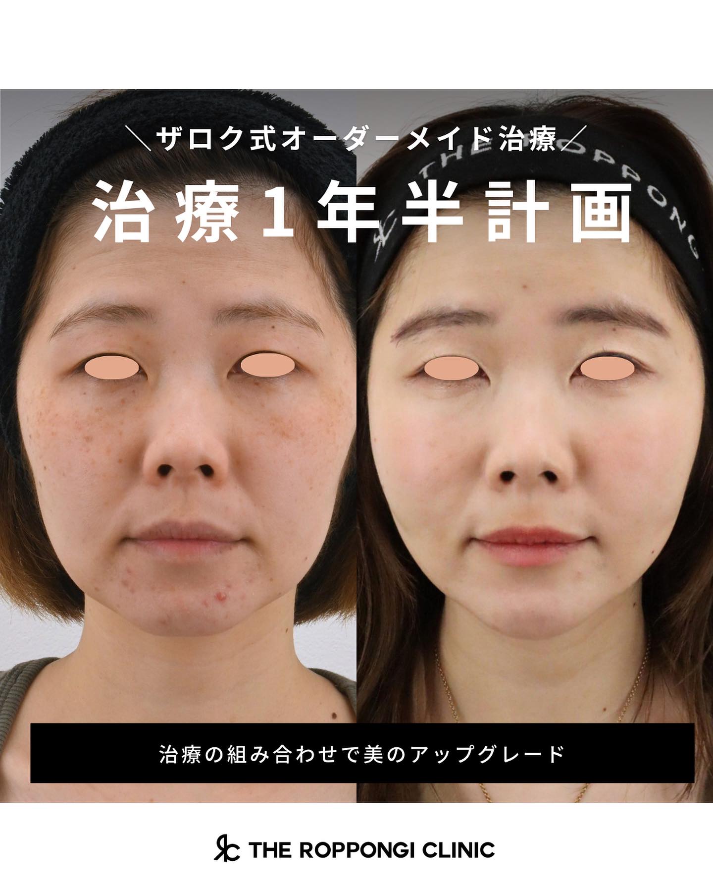 【ザロク式オーダーメイド治療】治療1年半計画