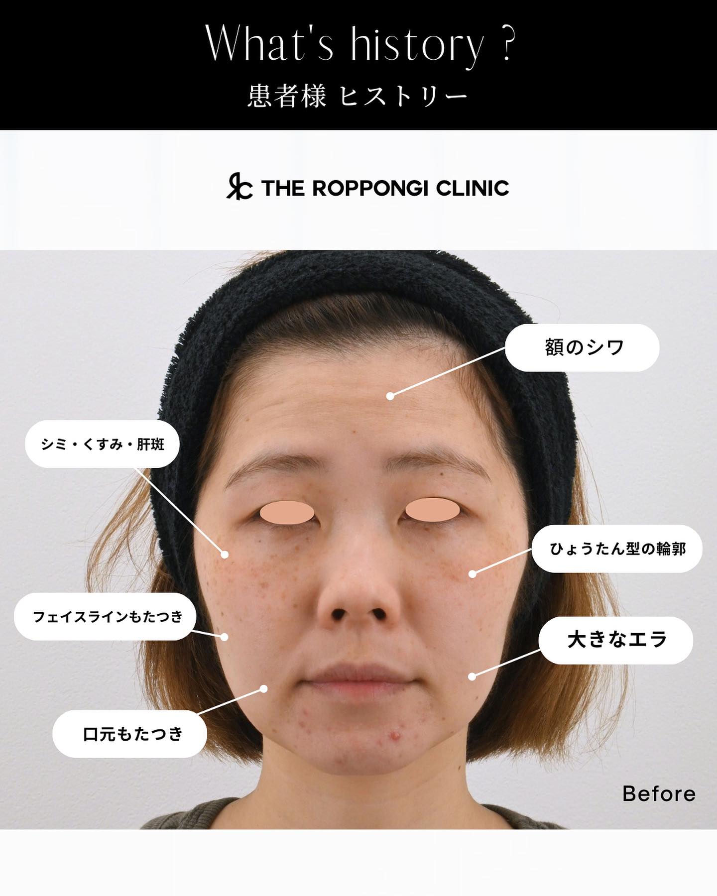 ピコレーザー、ピコトーニング、シミ治療、ヒアルロン酸注射、糸リフト