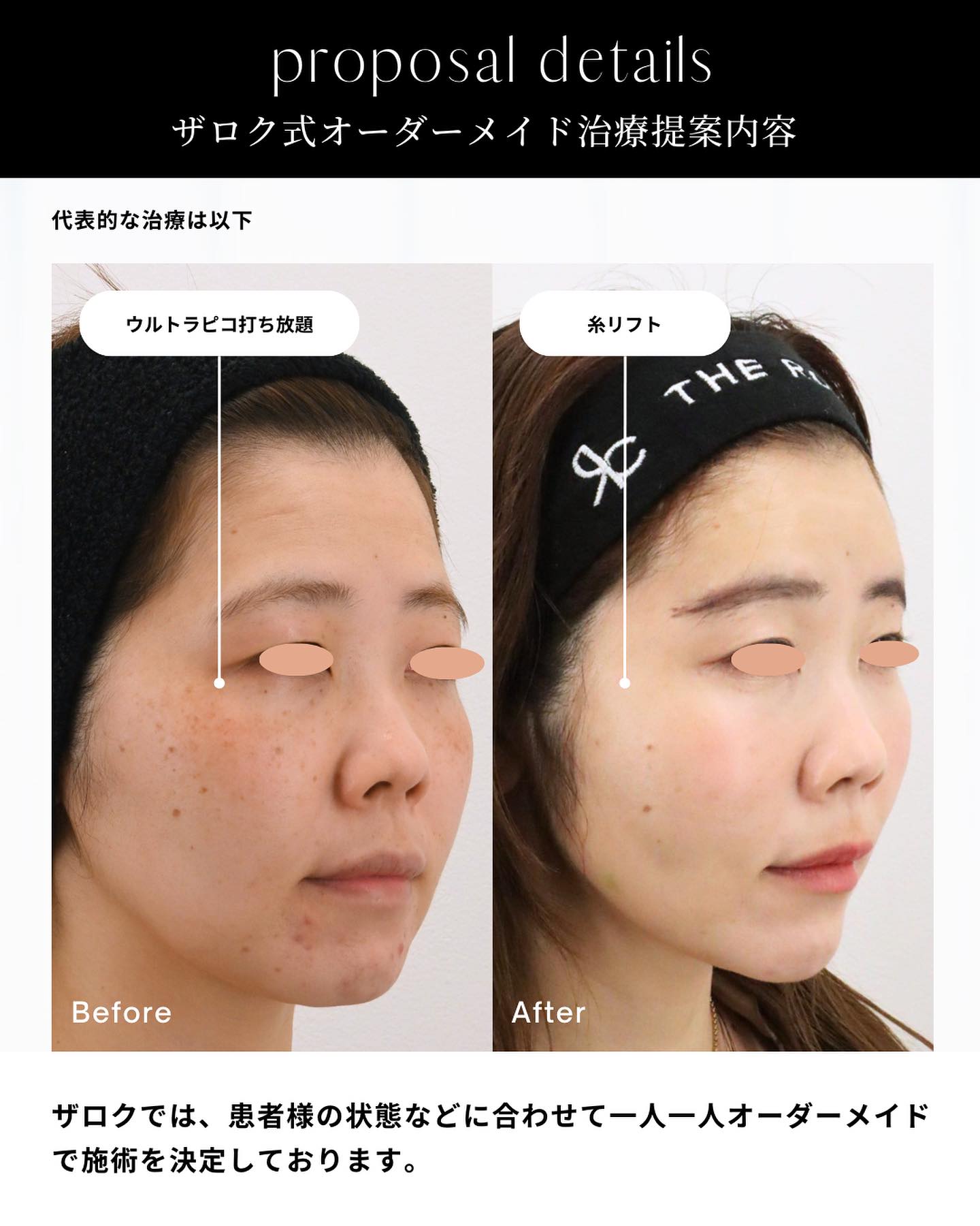 ピコレーザー、ピコトーニング、シミ治療、ヒアルロン酸注射、糸リフト