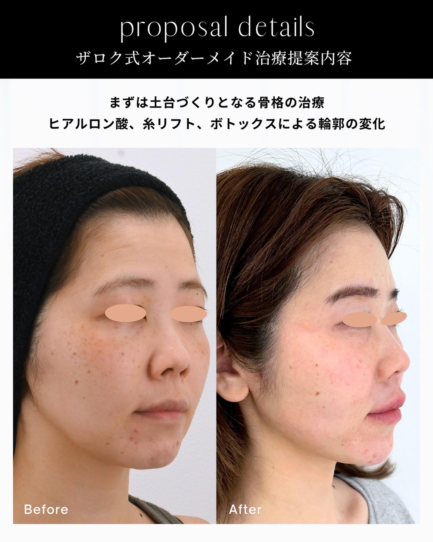 ピコレーザー、ピコトーニング、シミ治療、ヒアルロン酸注射、糸リフト