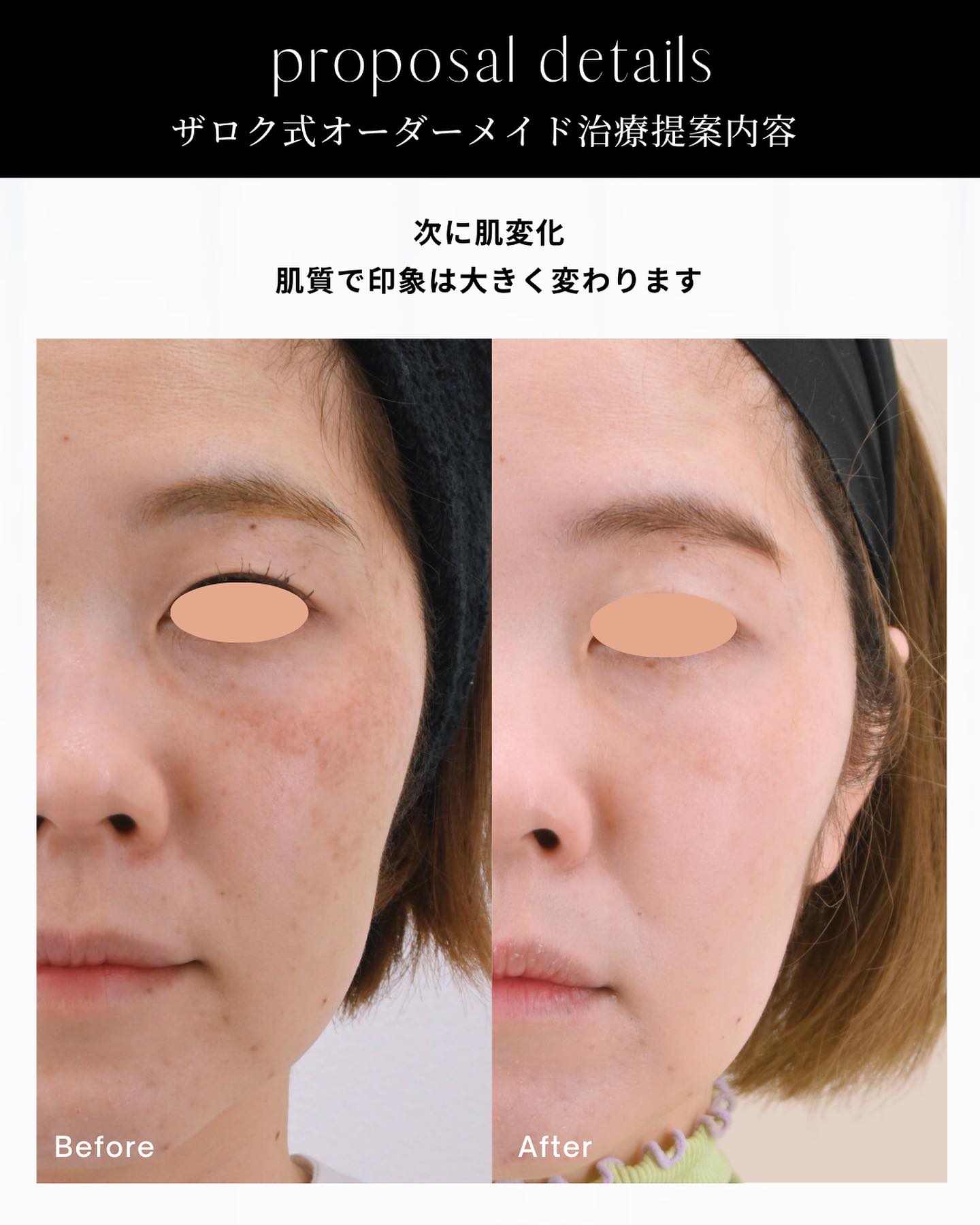 ピコレーザー、ピコトーニング、シミ治療、ヒアルロン酸注射、糸リフト