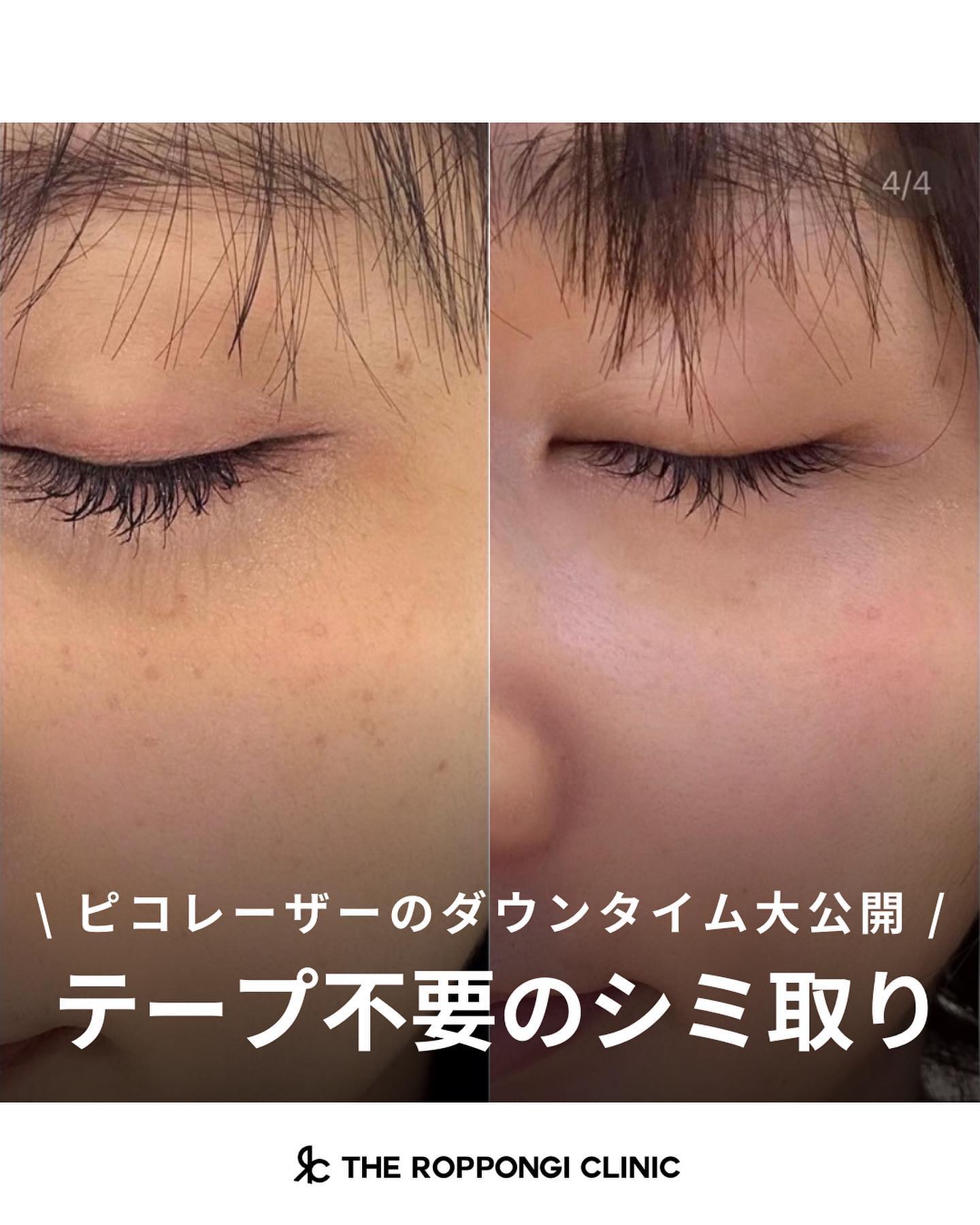 【テープ不要のシミ取り】ピコレーザーのダウンタイム大公開