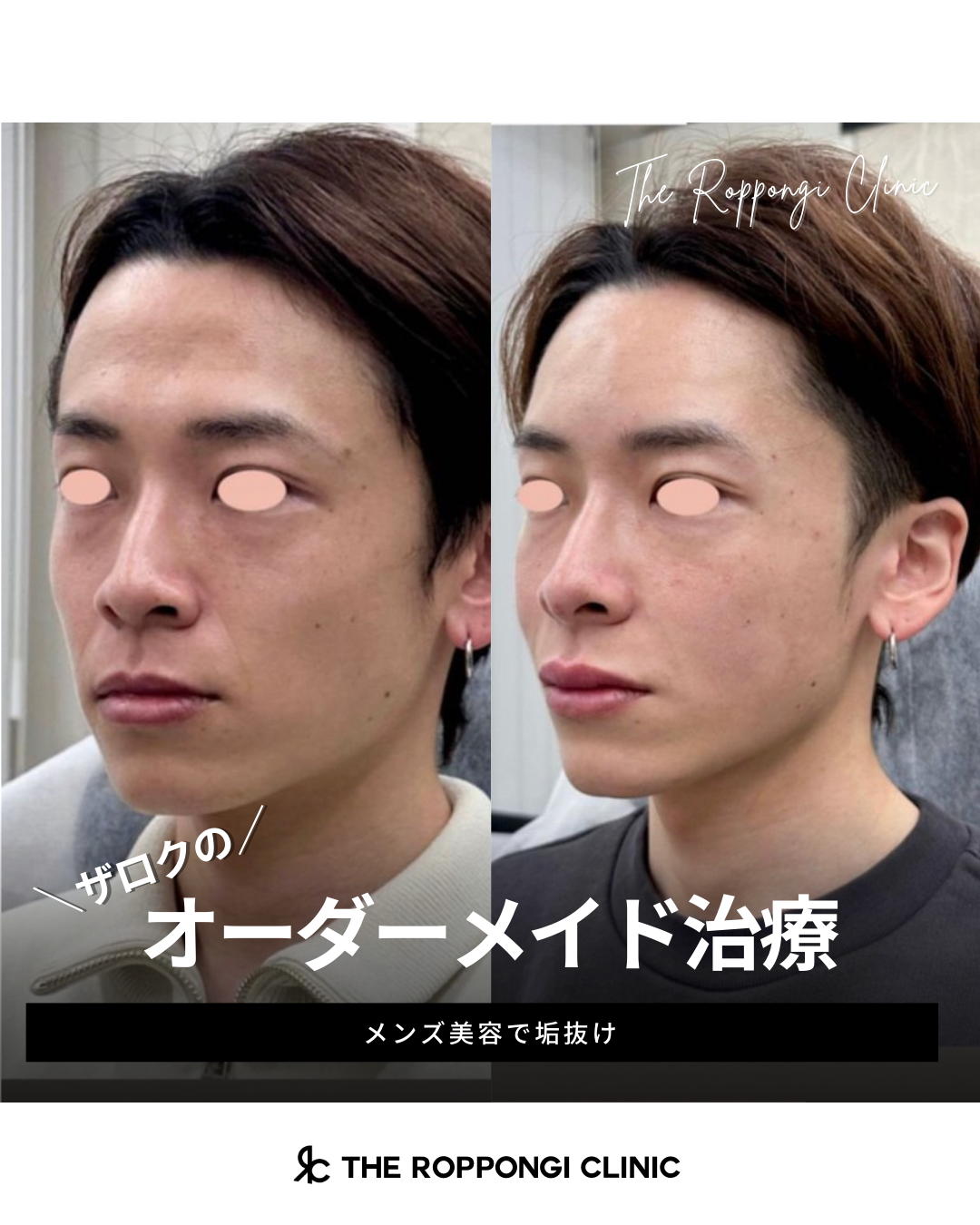 【ザロクのオーダーメイド治療】メンズ美容で垢抜け