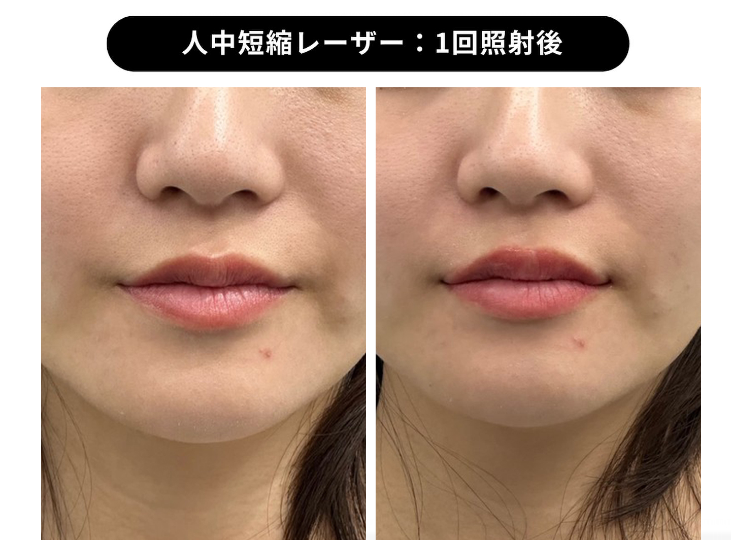 フォトナによる人中短縮