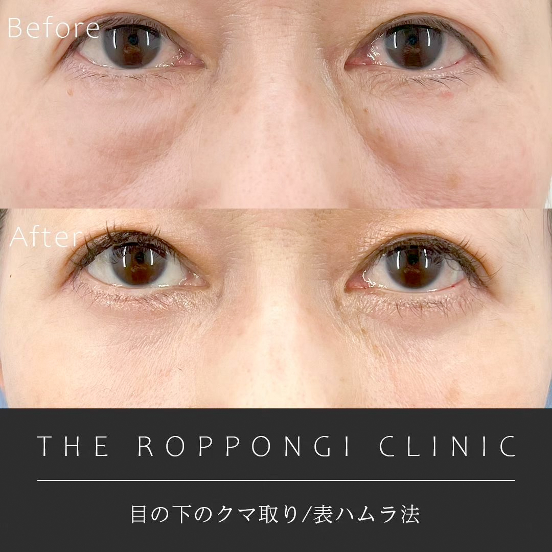 目の下のクマ取り(表ハムラ法)