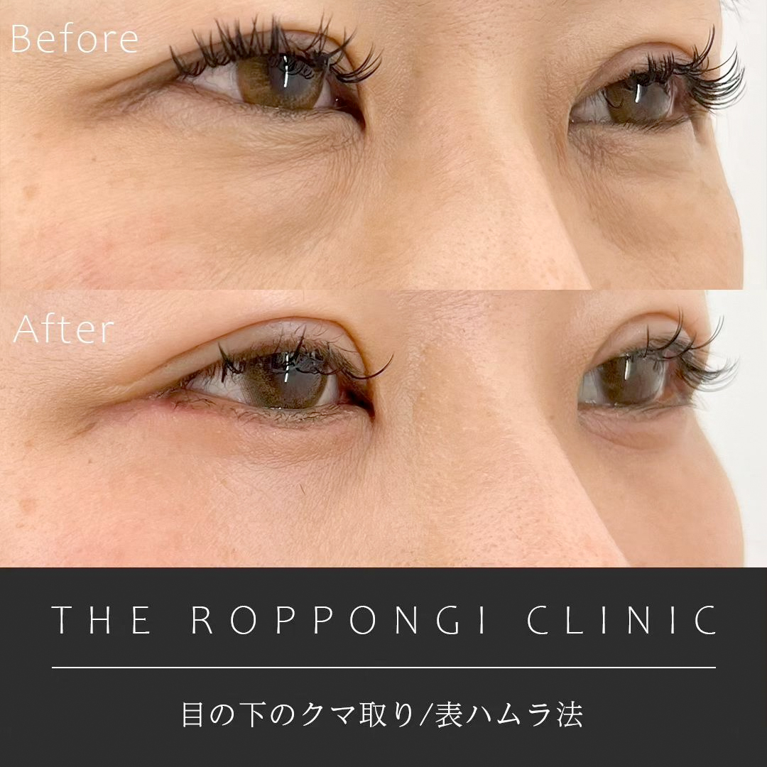 目の下のクマ取り(表ハムラ法)