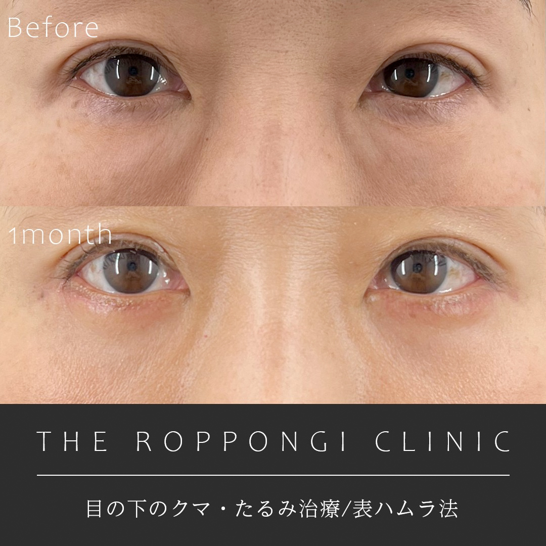 目の下のクマ取り(表ハムラ法)