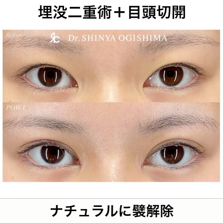 二重埋没術+目頭切開