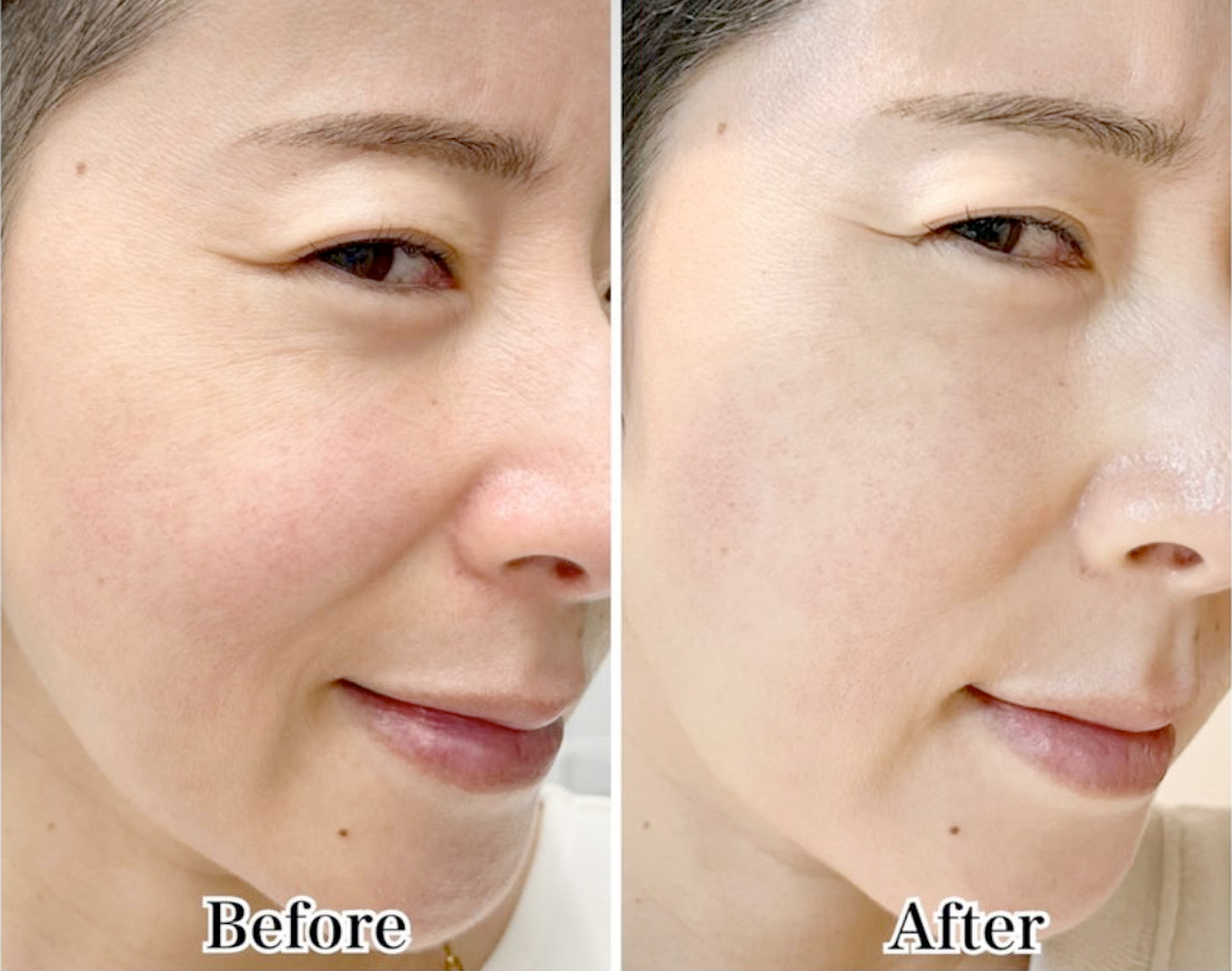 ちりめんジワはSTSで解決