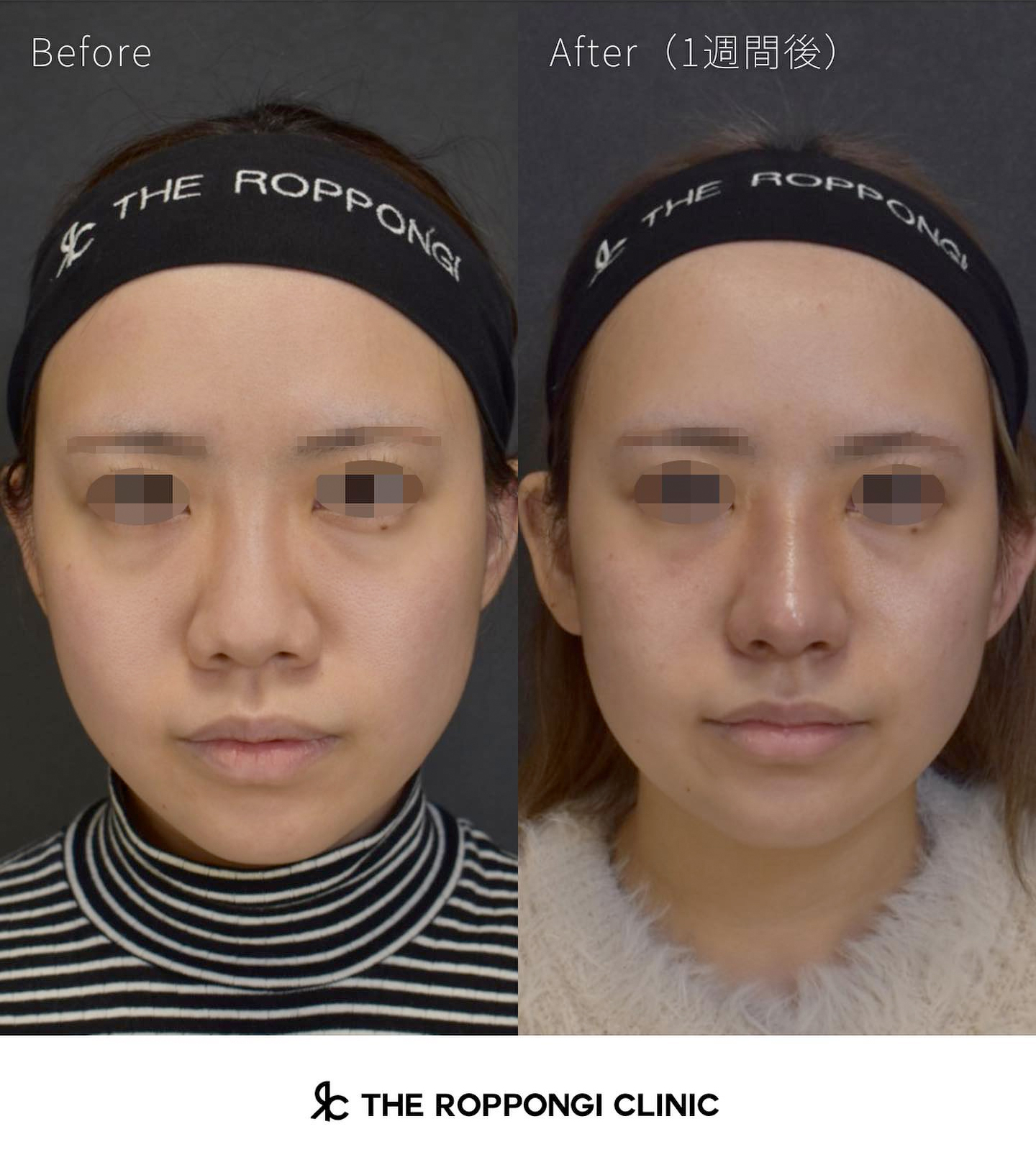 鼻整形、クローズド法自家組織隆鼻術