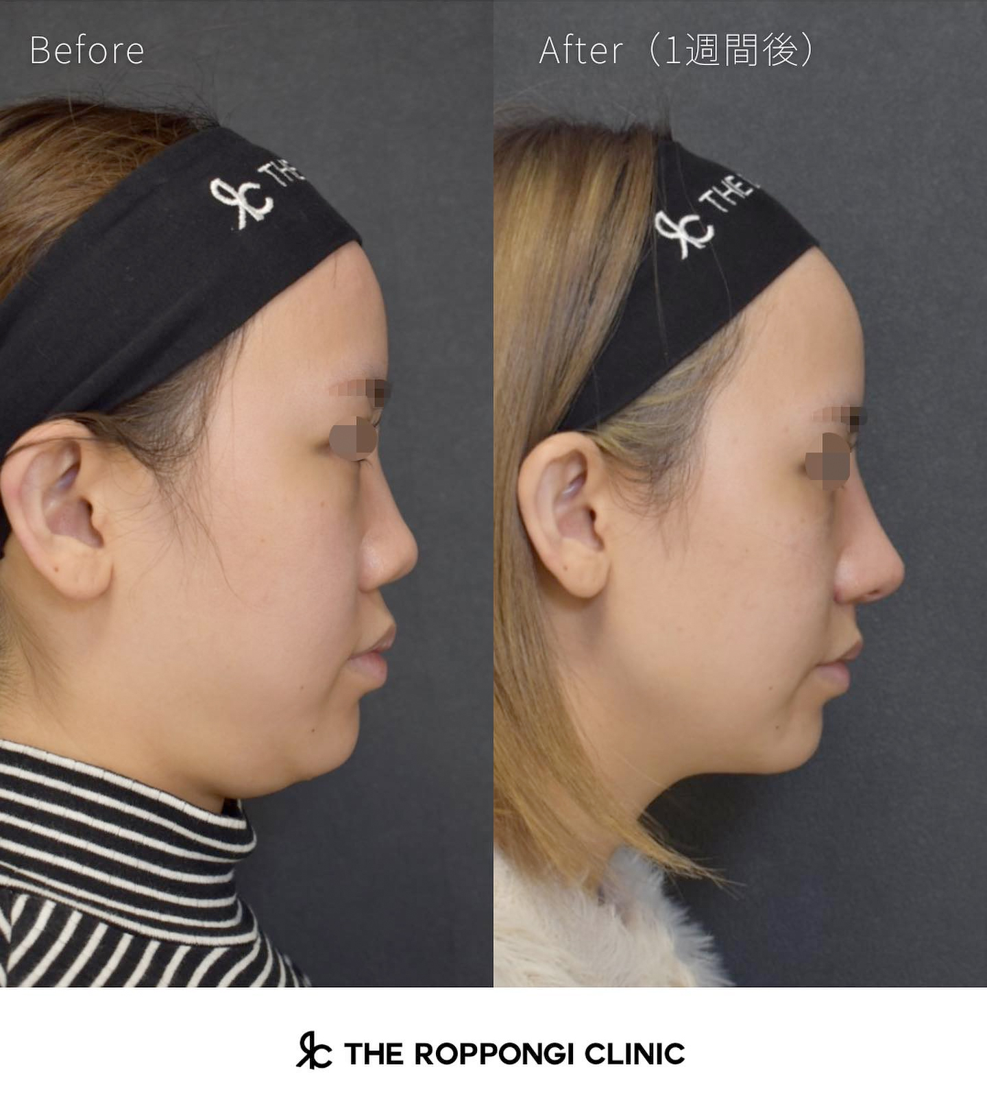 鼻整形、クローズド法自家組織隆鼻術