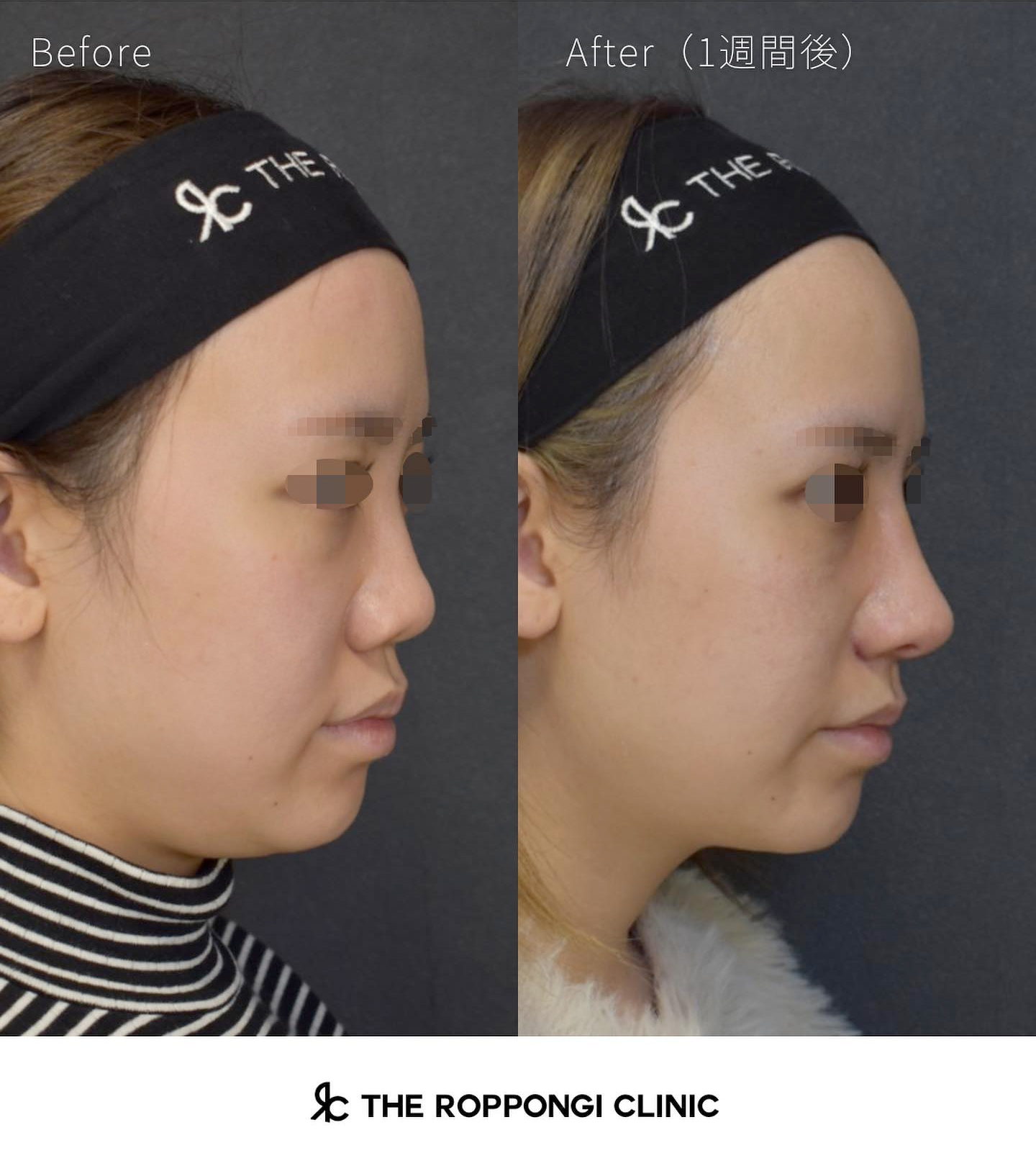 鼻整形、クローズド法自家組織隆鼻術