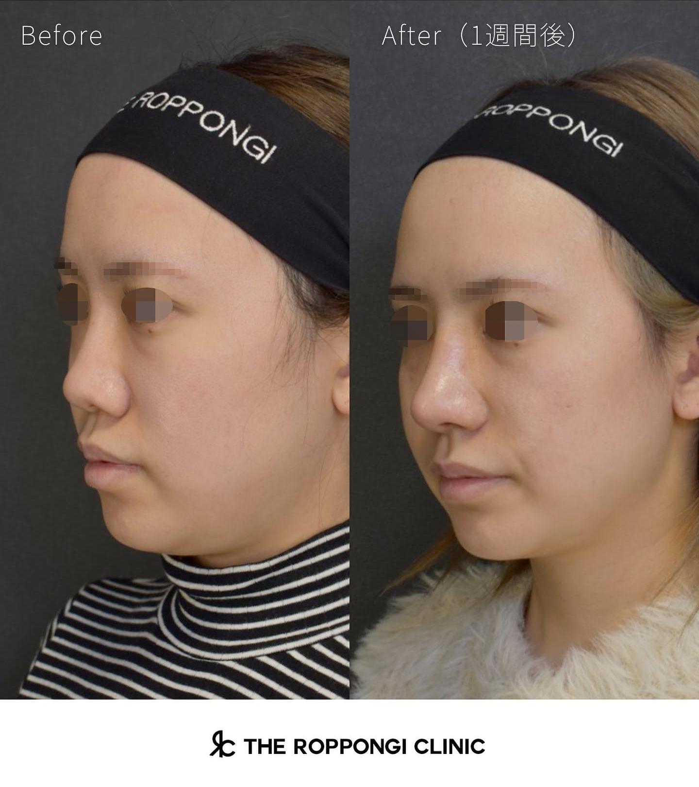 鼻整形、クローズド法自家組織隆鼻術