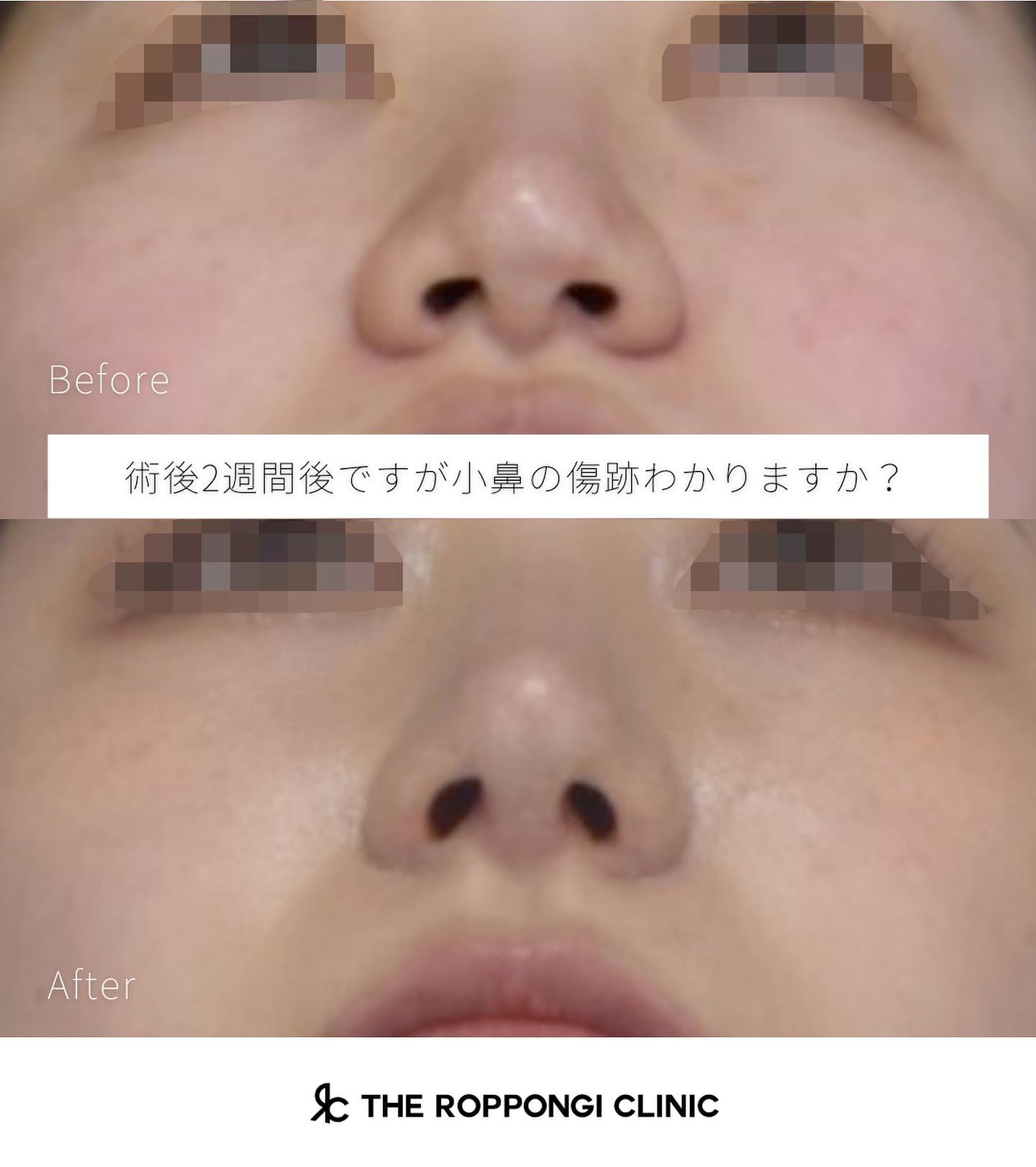 鼻整形、小鼻縮小