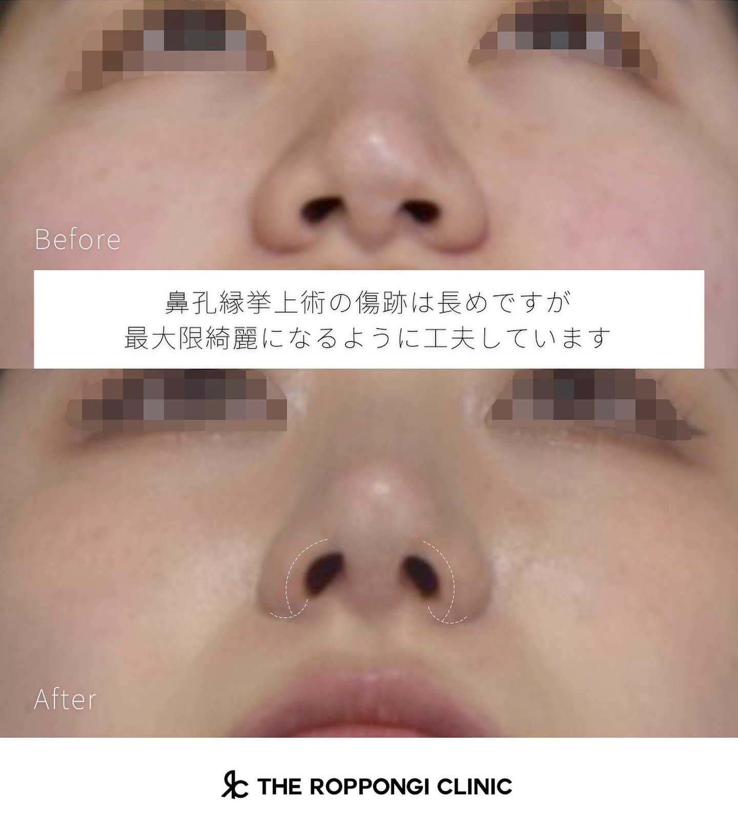 鼻整形、小鼻縮小