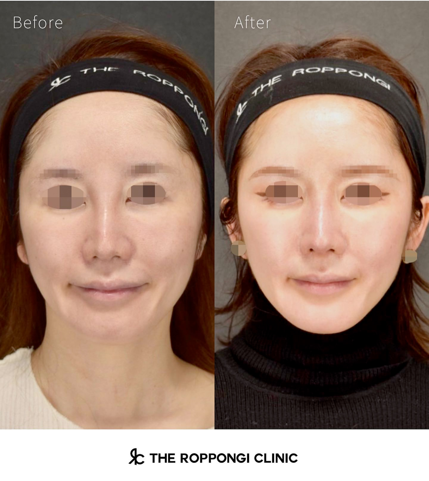 鼻整形、他院修正、異物除去