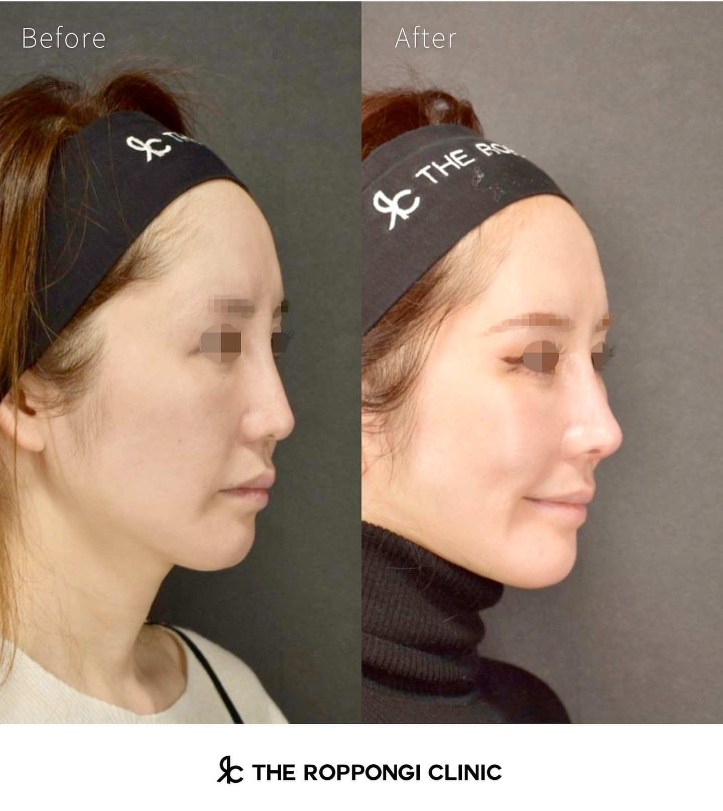 鼻整形、他院修正、異物除去