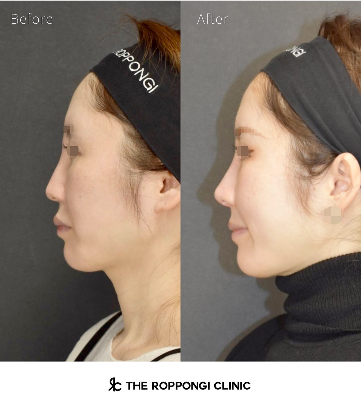 鼻整形、他院修正、異物除去