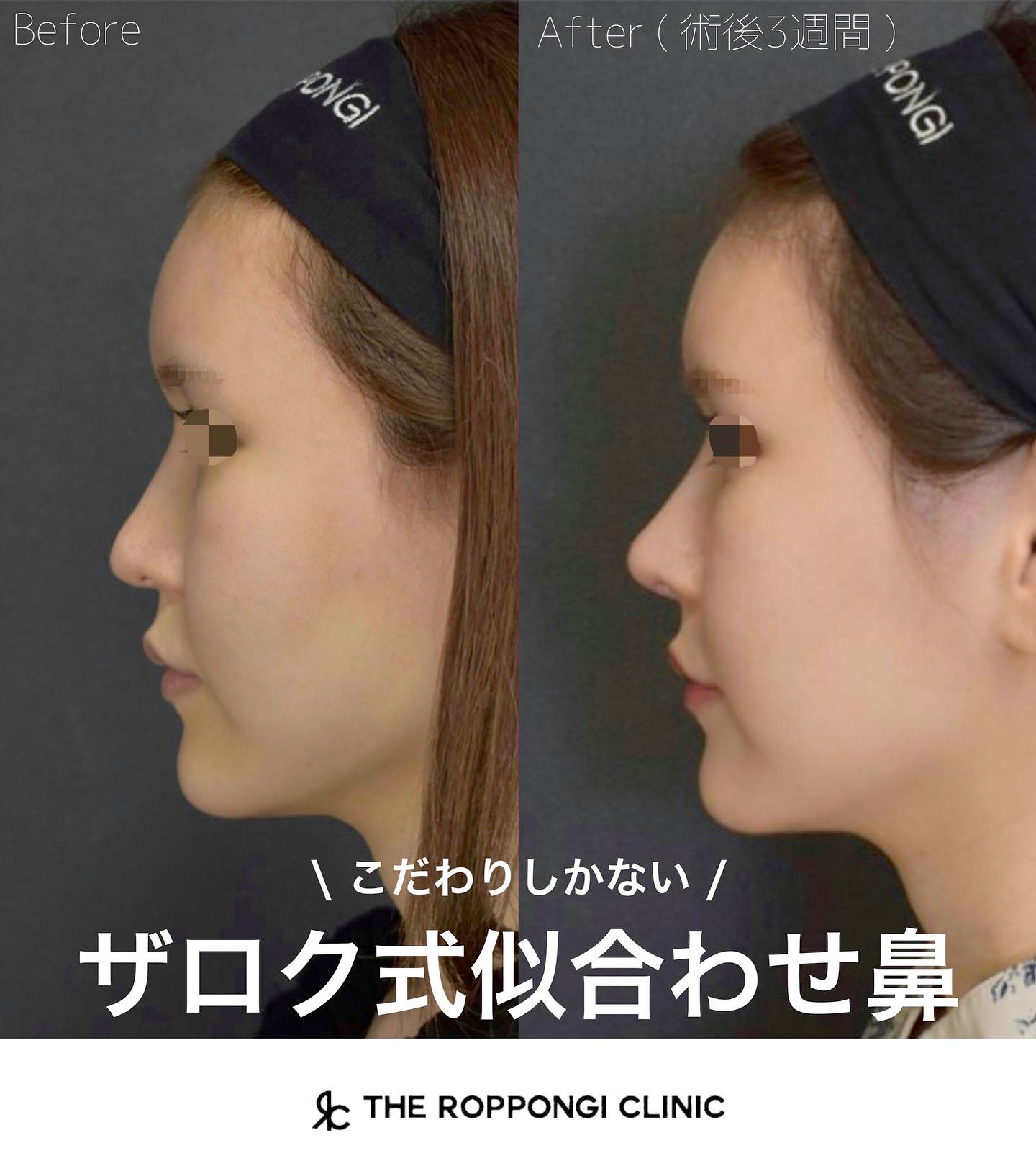 こだわりしかない【ザロク式似合わせ鼻】