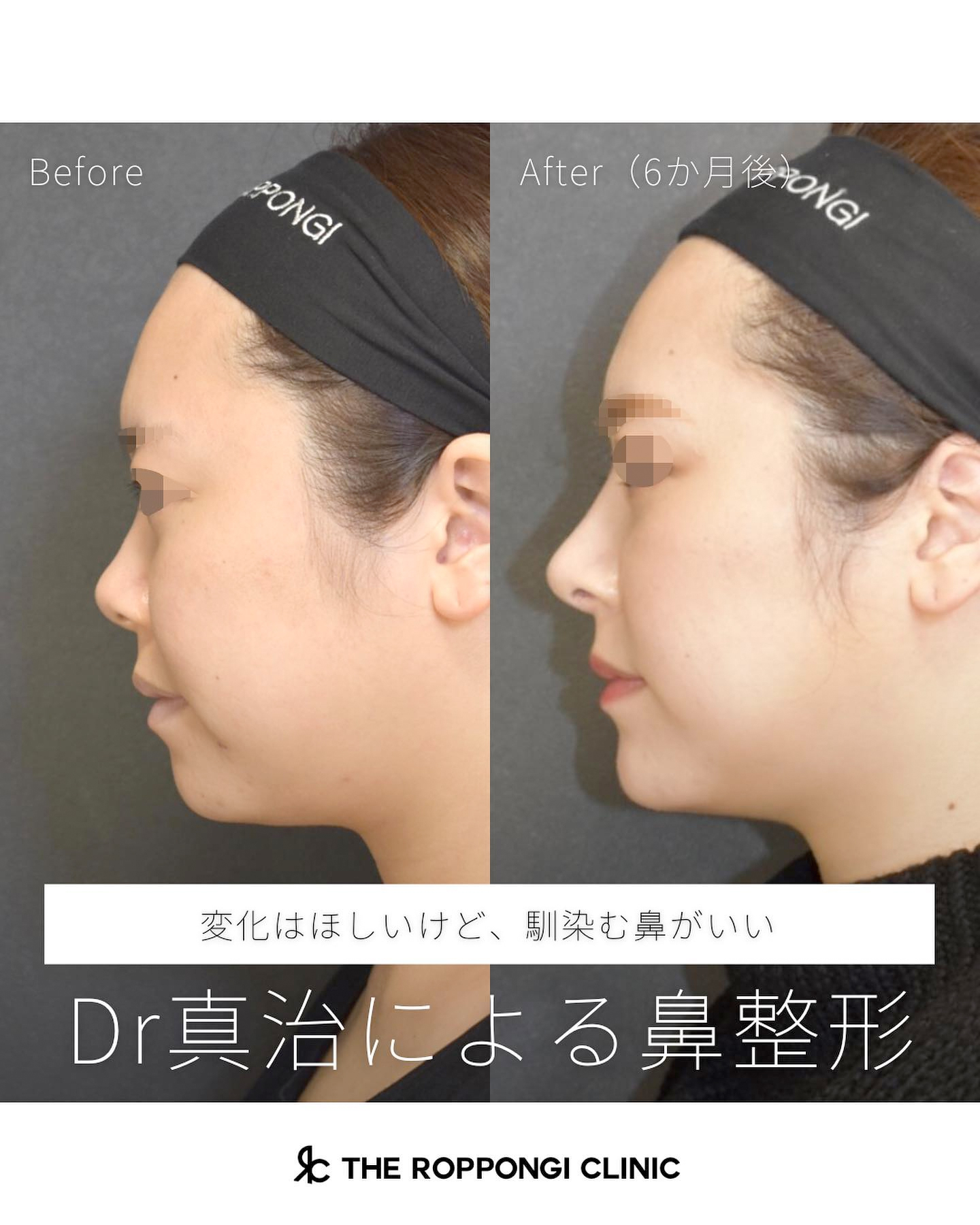 【Dr真治による鼻整形】変化は欲しいけど、馴染む鼻がいい