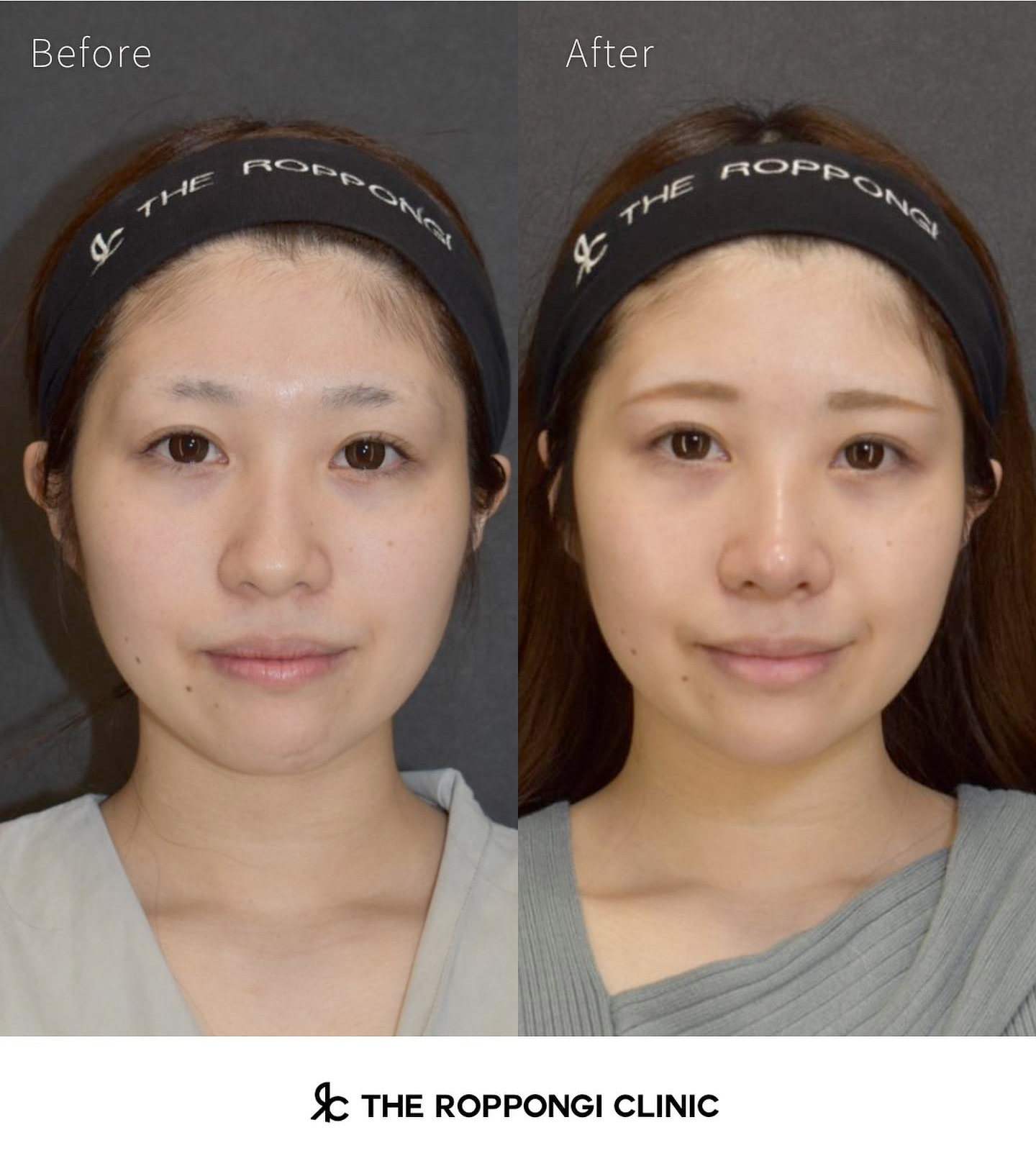 【Dr真治による鼻整形】鷲鼻から可愛らしい半ラウンドへ