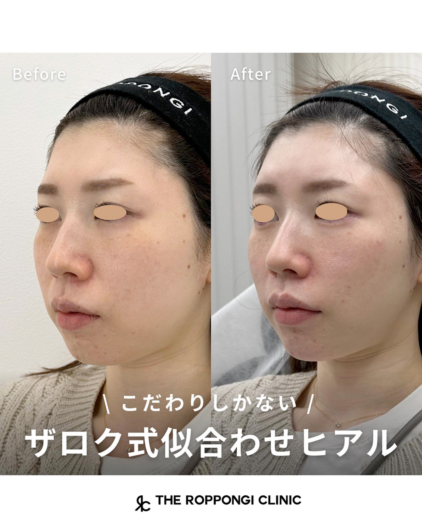 【ザロク式似合わせヒアルロン酸®︎】引き締まったお顔に