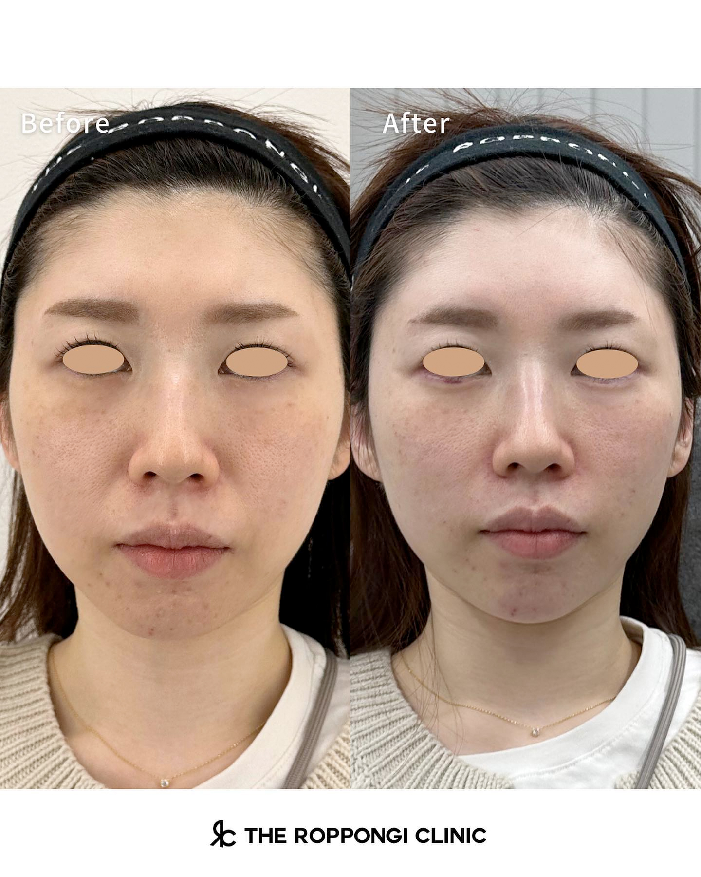 たるみ治療、ヒアルロン酸注射