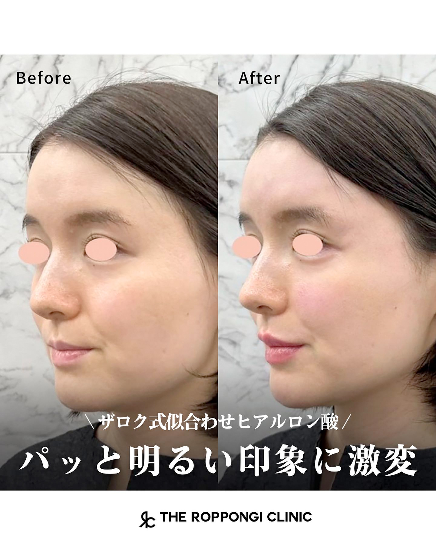 【ザロク式似合わせヒアルロン酸®︎】パッと明るい印象に激変